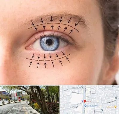 عمل افتادگی پلک در خیابان توحید اصفهان