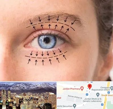 عمل افتادگی پلک در جردن