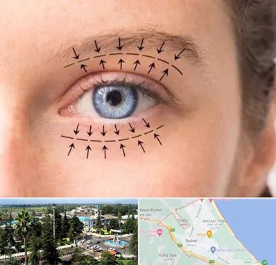 عمل افتادگی پلک در رودسر