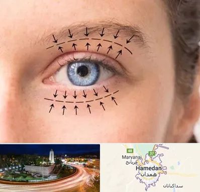 عمل افتادگی پلک در همدان