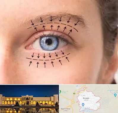 عمل افتادگی پلک در برازجان