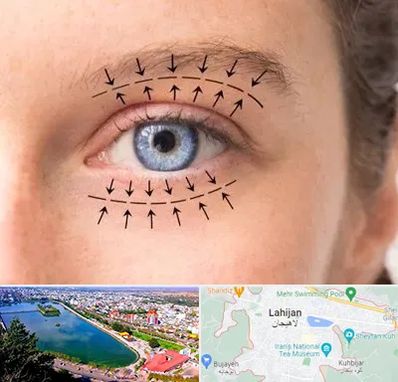 عمل افتادگی پلک در لاهیجان