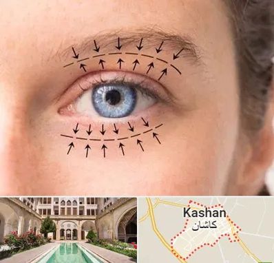 عمل افتادگی پلک در کاشان