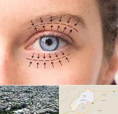 عمل افتادگی پلک در شاهرود