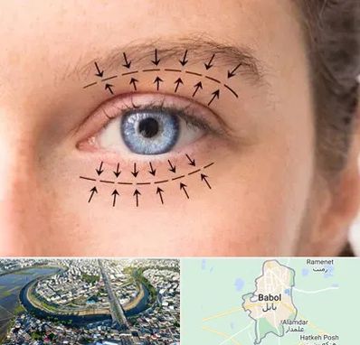 عمل افتادگی پلک در بابل
