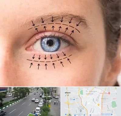 عمل افتادگی پلک در ستارخان