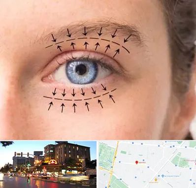 عمل افتادگی پلک در بلوار سجاد مشهد