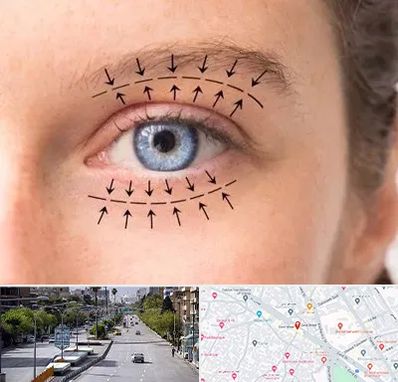 عمل افتادگی پلک در خیابان زند شیراز