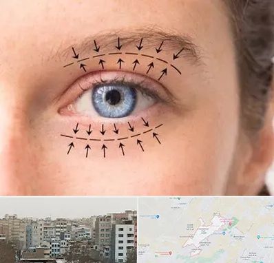 عمل افتادگی پلک در محمد شهر کرج