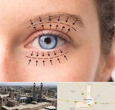عمل افتادگی پلک در سبزوار