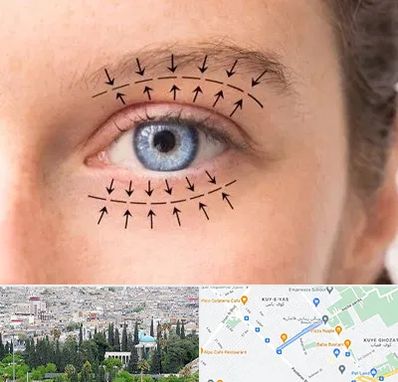 عمل افتادگی پلک در محلاتی شیراز