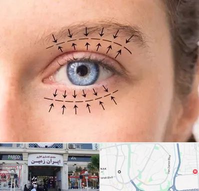 عمل افتادگی پلک در ایران زمین