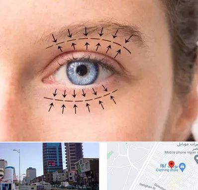 عمل افتادگی پلک در چهارراه طالقانی کرج