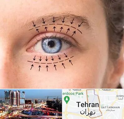 عمل افتادگی پلک در صادقیه تهران