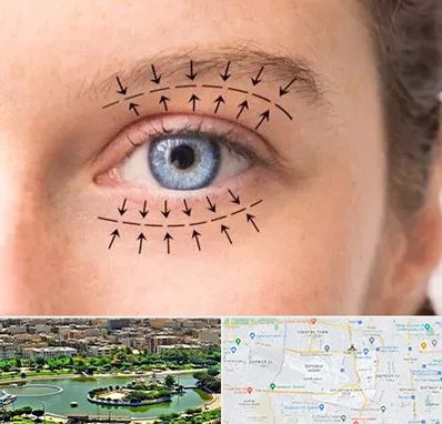 عمل افتادگی پلک در منطقه 9 تهران