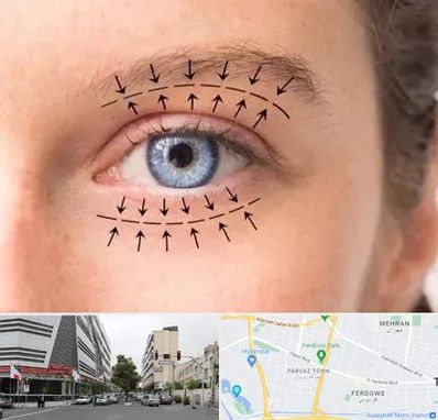 عمل افتادگی پلک در بلوار فردوس
