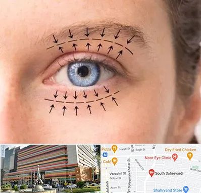 عمل افتادگی پلک در سهروردی