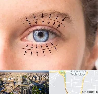 عمل افتادگی پلک در استاد معین