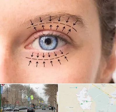 عمل افتادگی پلک در نظرآباد کرج