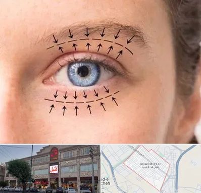 عمل افتادگی پلک در قائمیه اسلامشهر