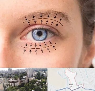 عمل افتادگی پلک در اوین