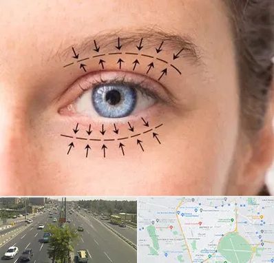 عمل افتادگی پلک در منطقه 17 تهران