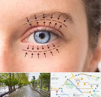 عمل افتادگی پلک در خیابان ارم شیراز