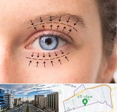 عمل افتادگی پلک در سعادت آباد تهران