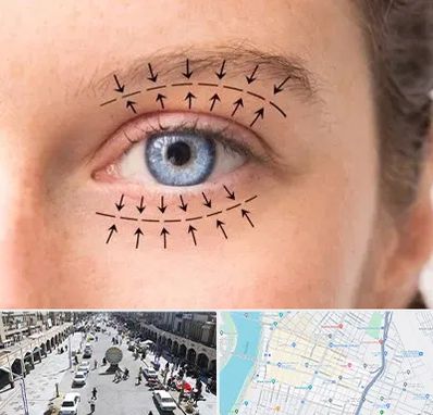 عمل افتادگی پلک در نادری اهواز