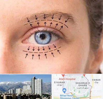عمل افتادگی پلک در شهرک غرب تهران