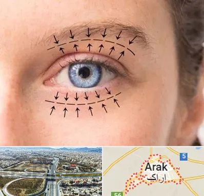 عمل افتادگی پلک در اراک