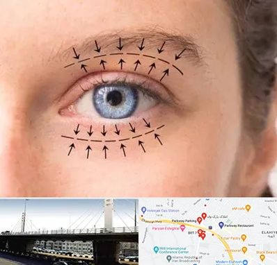 عمل افتادگی پلک در پارک وی