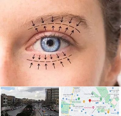 عمل افتادگی پلک در بلوار فردوسی مشهد