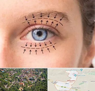 عمل افتادگی پلک در دماوند