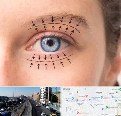 عمل افتادگی پلک در پیروزی