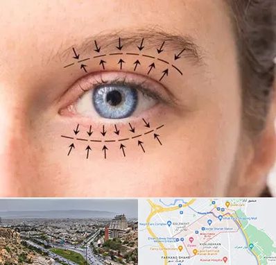 عمل افتادگی پلک در معالی آباد شیراز