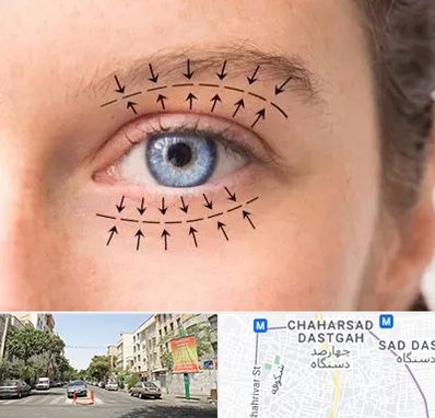 عمل افتادگی پلک در چهارصد دستگاه