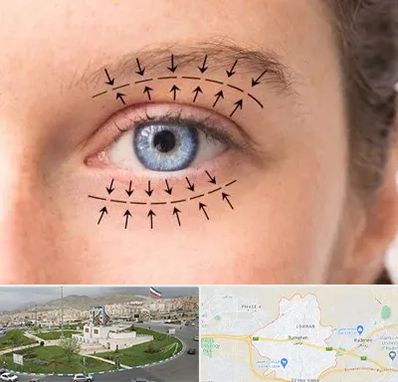 عمل افتادگی پلک در بومهن