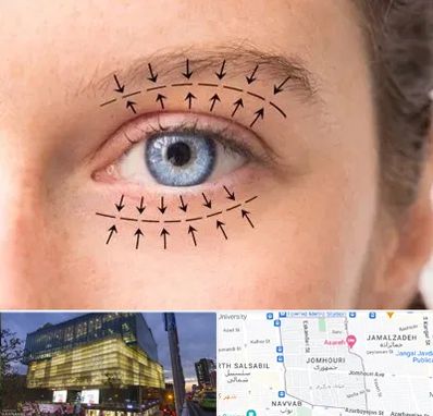 عمل افتادگی پلک در جمهوری