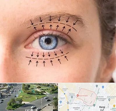 عمل افتادگی پلک در شاهین ویلا کرج