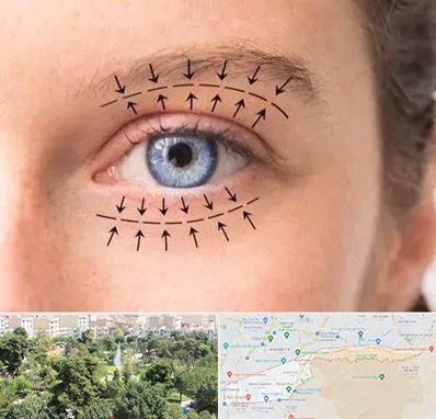 عمل افتادگی پلک در منطقه 13 تهران