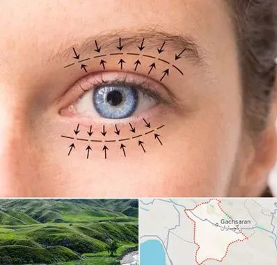 عمل افتادگی پلک در گچساران