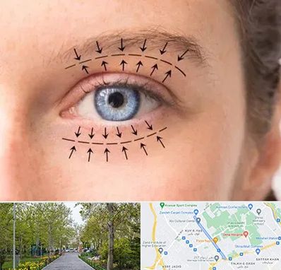 عمل افتادگی پلک در قدوسی غربی شیراز