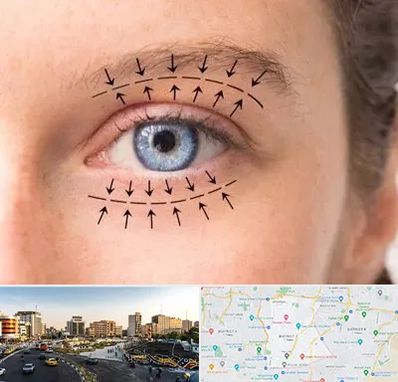 عمل افتادگی پلک در منطقه 7 تهران