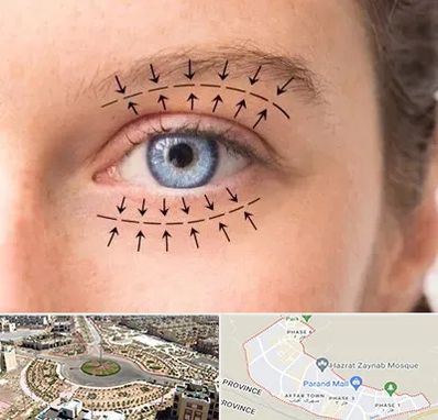 عمل افتادگی پلک در پرند