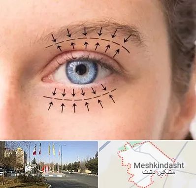 عمل افتادگی پلک در مشکین دشت