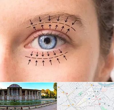 عمل افتادگی پلک در عفیف آباد شیراز