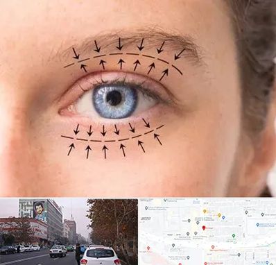 عمل افتادگی پلک در کارگر شمالی