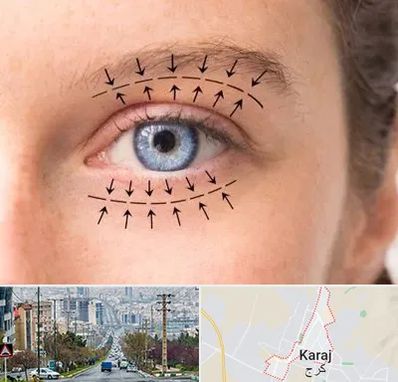 عمل افتادگی پلک در گوهردشت