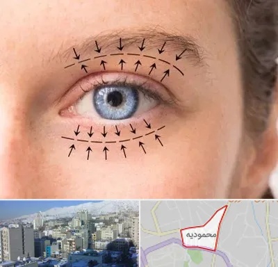 عمل افتادگی پلک در محمودیه